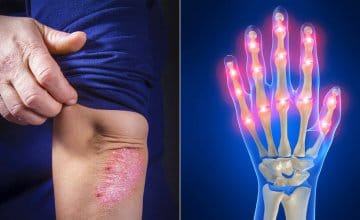 Psorijaza artritis simptomi
