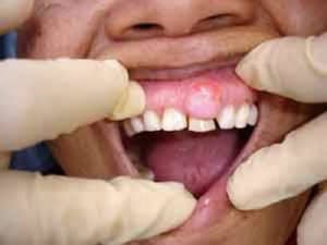 Psorijaza i pokvareni zubi
