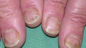 Psorijaza nokta liječenje